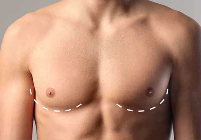 عملية شفط الدهون لتصغير الثدي عند الرجال