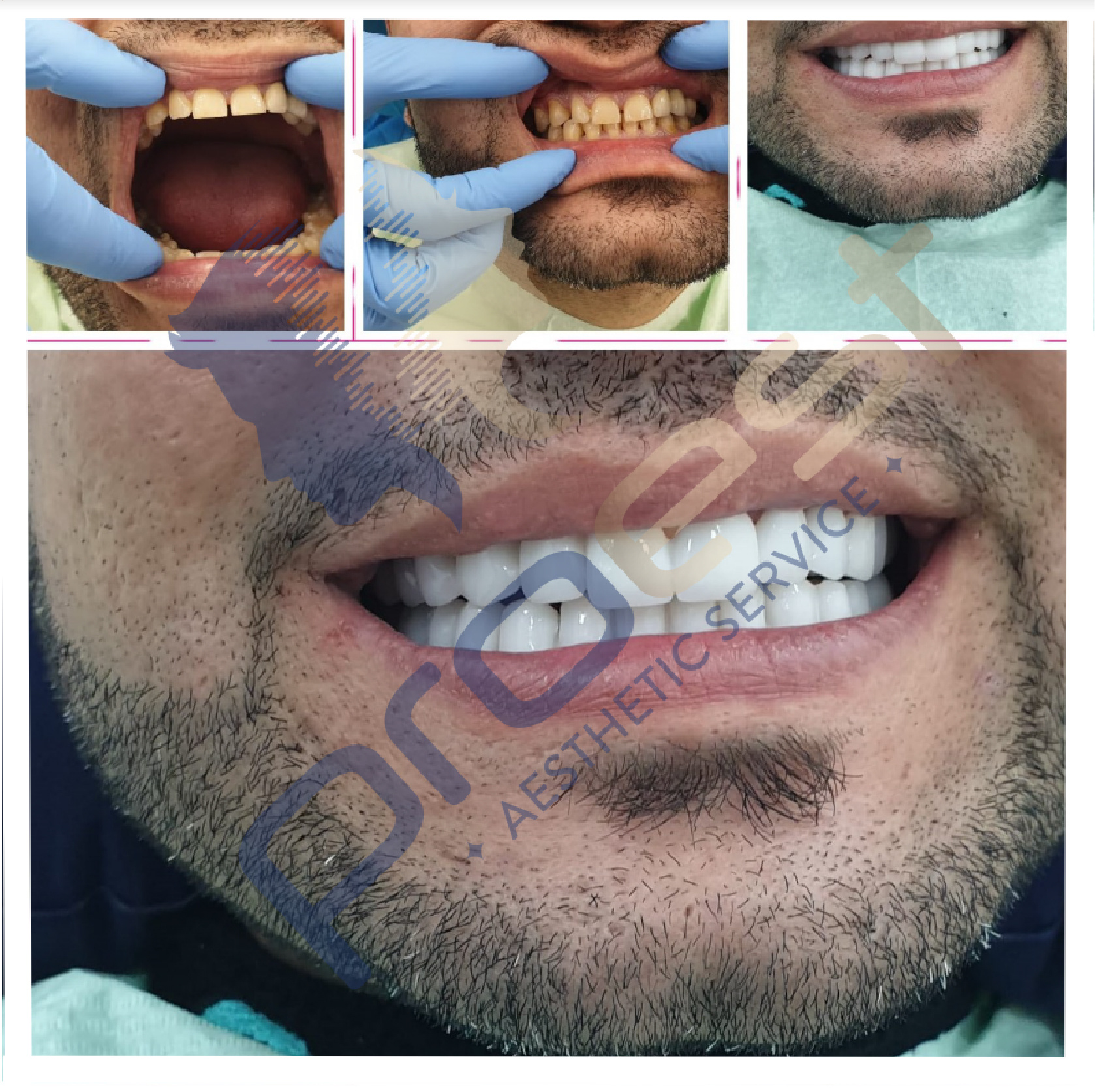 Dental Aesthetics
