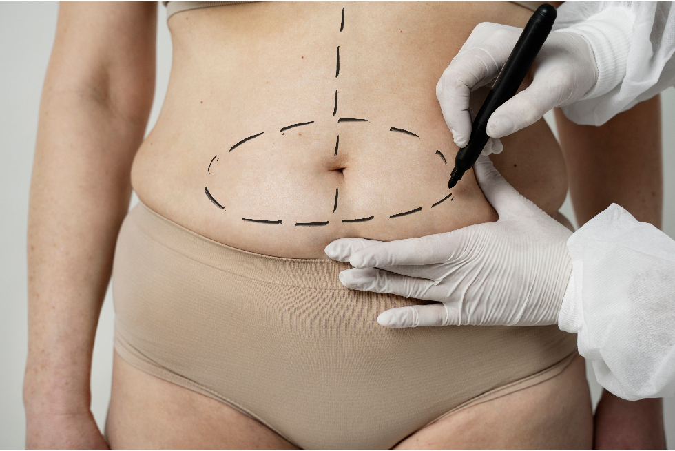 Abdominoplastie + liposuction 360